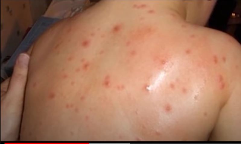 Alarm zbog opasnosti od epidemije malih boginja u Crnoj Gori